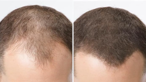 Rezultat korišćenja Minoksidila kod muškarca – pre i posle