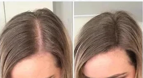 Rezultat korišćenja Minoksidila kod zene – pre i posle