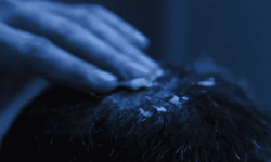 Muškarac umasirava minoksidil u vlasište – završni korak za optimalan efekat